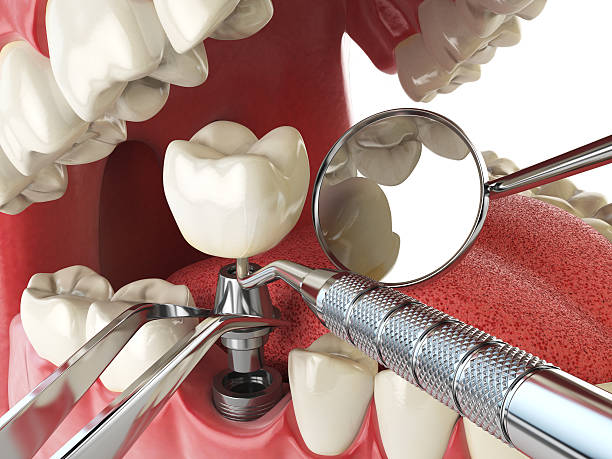 Best Emergency Root Canal Treatment in Richton, MS